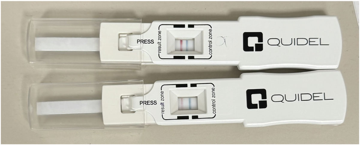 InflammaDry positive results for matrix metalloproteinase-9, an inflammatory marker elevated in tears of dry eye patients.