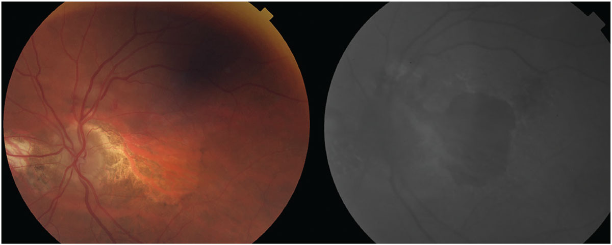 The left photo depicts advanced AMD with extensive, central GA. At right is an FAF photo showing extensive amounts of central hypofluorescence due to retinal pigment epithelium loss and a small area of hypofluorescence superior to the optic nerve caused by increased metabolic activity from the neovascular membrane. 