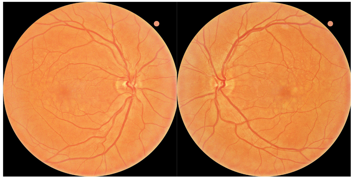 Fig. 1. Baseline fundus photography revealed large soft drusen bilaterally consistent with intermediate stage AMD. The patient was referred to the ForeseeHome AMD Monitoring Program and instructed to follow up in six months.