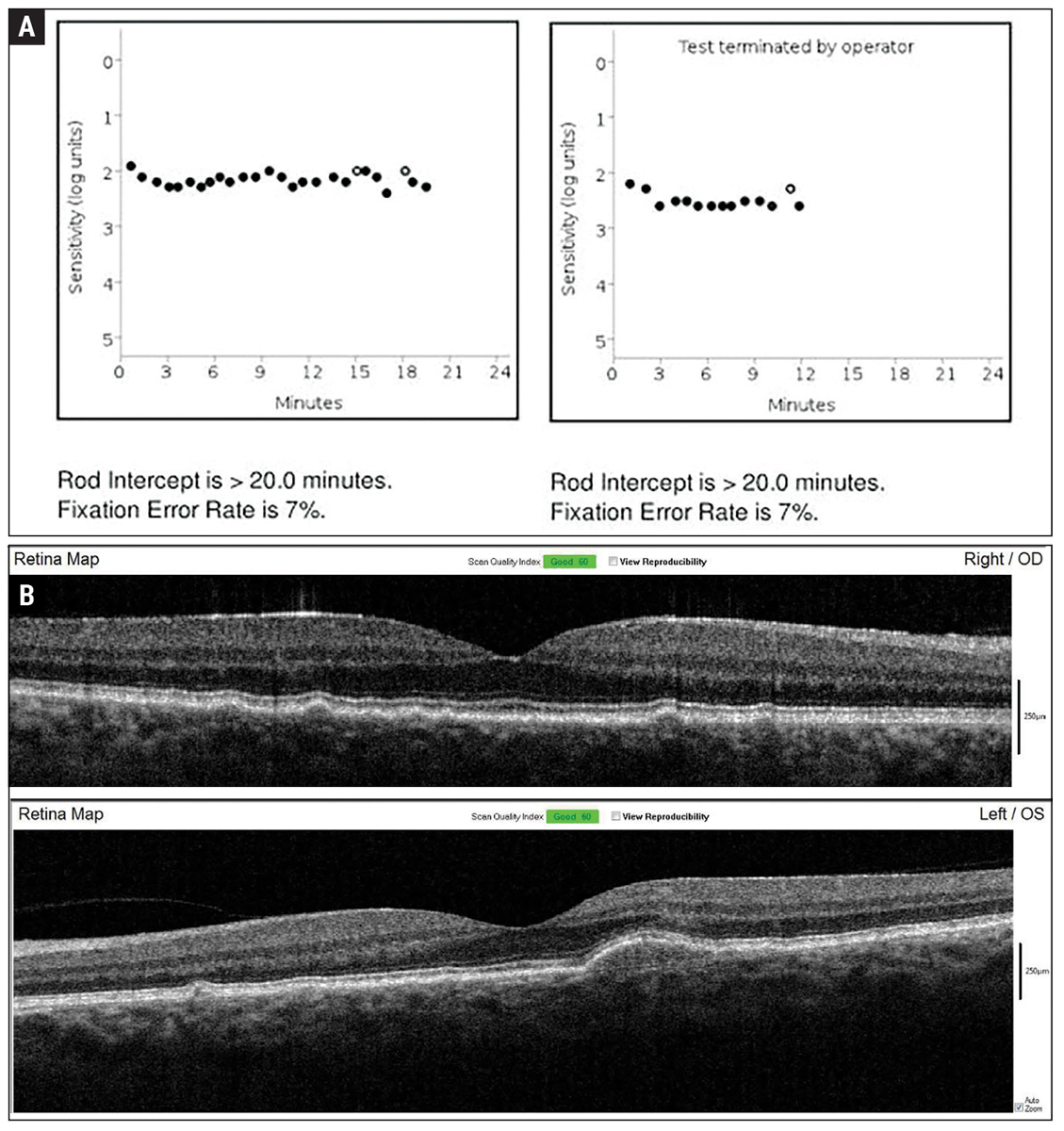 Fig. 2. Baseline dark adaptation (A) and OCT imaging (B) were established in-office upon initiation of home monitoring for wet exudative AMD conversion.