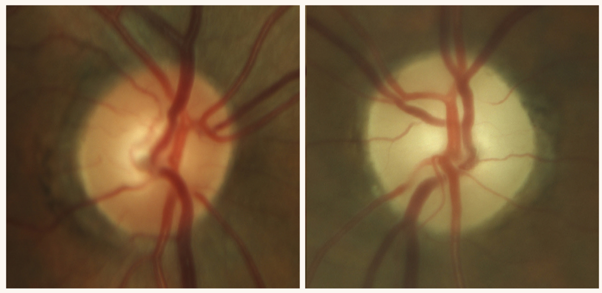 Late-stage, severe optic atrophy in a patient on chronic amiodarone therapy, an anti-arrhythmic drug. 