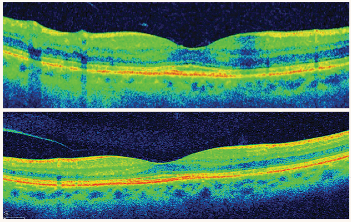 OCT demonstrating localized parafoveal thinning in a patient with early HCQ toxicity.