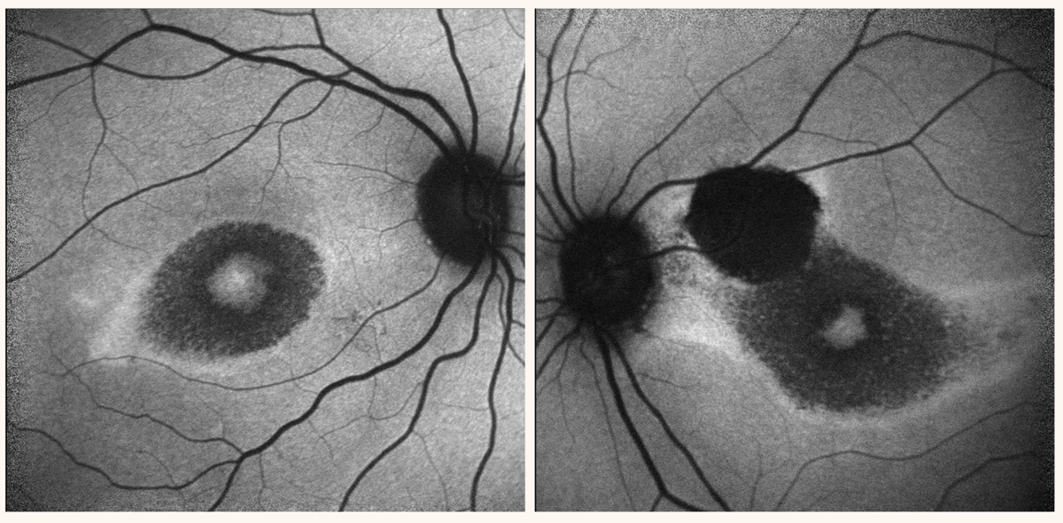 Perifoveal hypoautofluorescence in both eyes and a dense hypoautofluorescent lesion in the superonasal macula consistent with the chorioretinal scar observed on fundus exam.