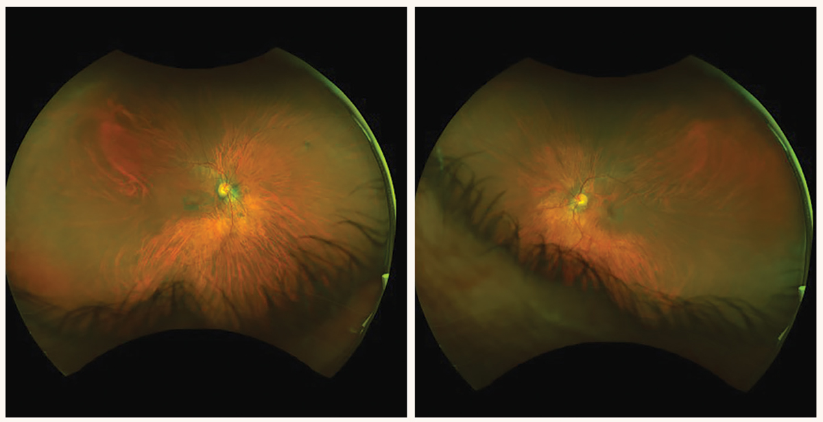 Five years after this patient stopped taking HCQ, these fundus images highlight some of the damage it left behind. Note the incomplete bullseye maculopathy at left. 