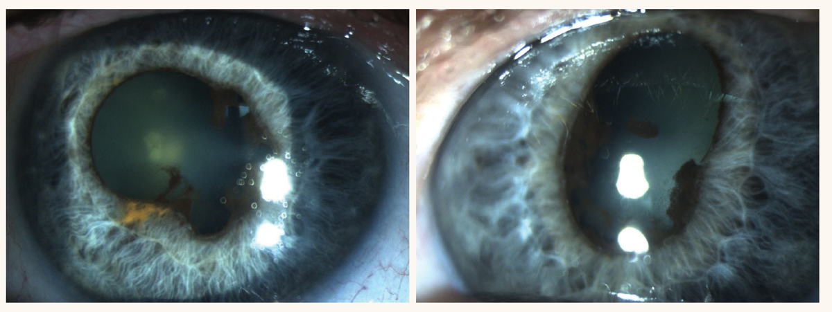 Findings due to chronic anterior uveitis associated with a cancer immunotherapy drug.