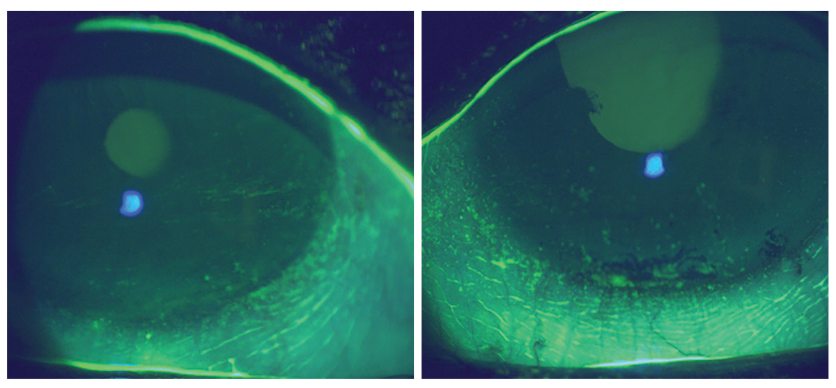 Eight weeks following initiation of prescription medication therapy with continued use of artificial tears, eyelid hygiene and moist heat mask use. 