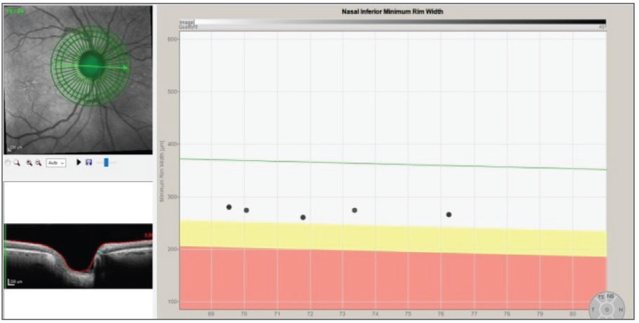 Fig. 1. The progression analysis of the right neuroretinal rim demonstrates no significant deterioration.