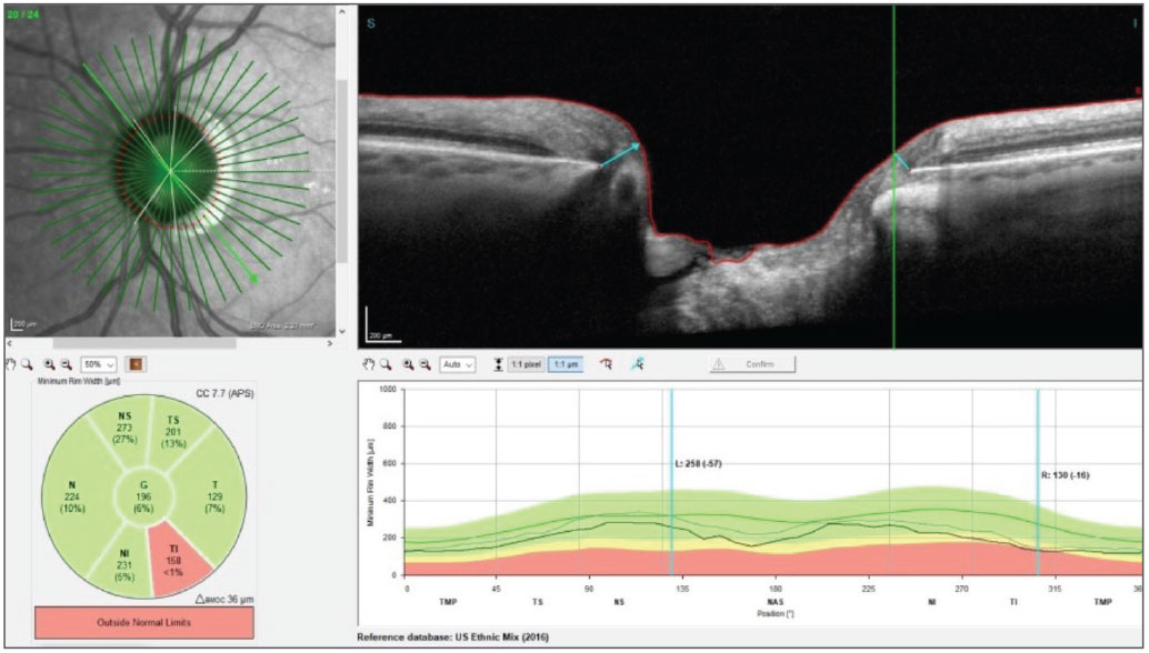 Fig. 5. The changes to the BMO-MRW readings in the left eye from baseline until the most recent visit. Notice the global reduction in neuroretinal rim thickness.