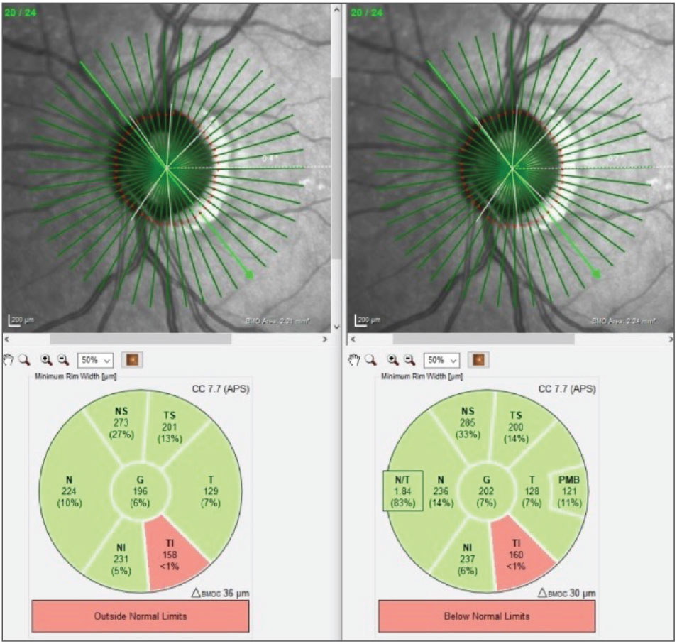 Fig. 6. The BMO-MRW scans using glaucoma software on the left and the neuro on the right. Note the Garway-Heath sectors are almost identical between the differing scans.