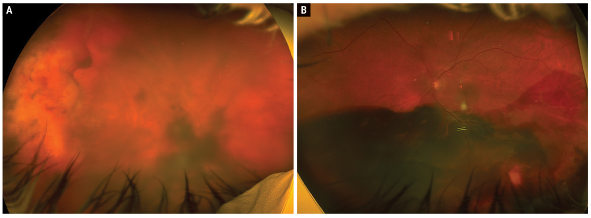 Fig. 1. Optos widefield fundus photos of the right eye (A) and left eye (B).