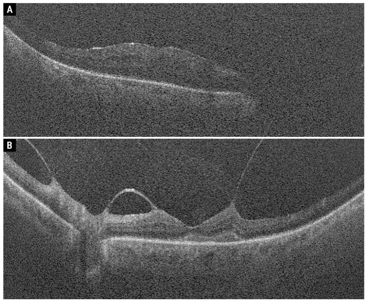 Fig. 4. Macular OCT scans of the right eye (A) and left eye (B).