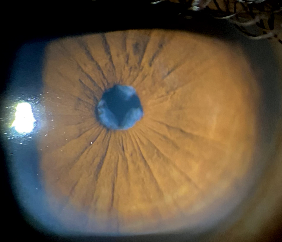 A wispy membrane can be seen through the pupil on biomicroscopy.