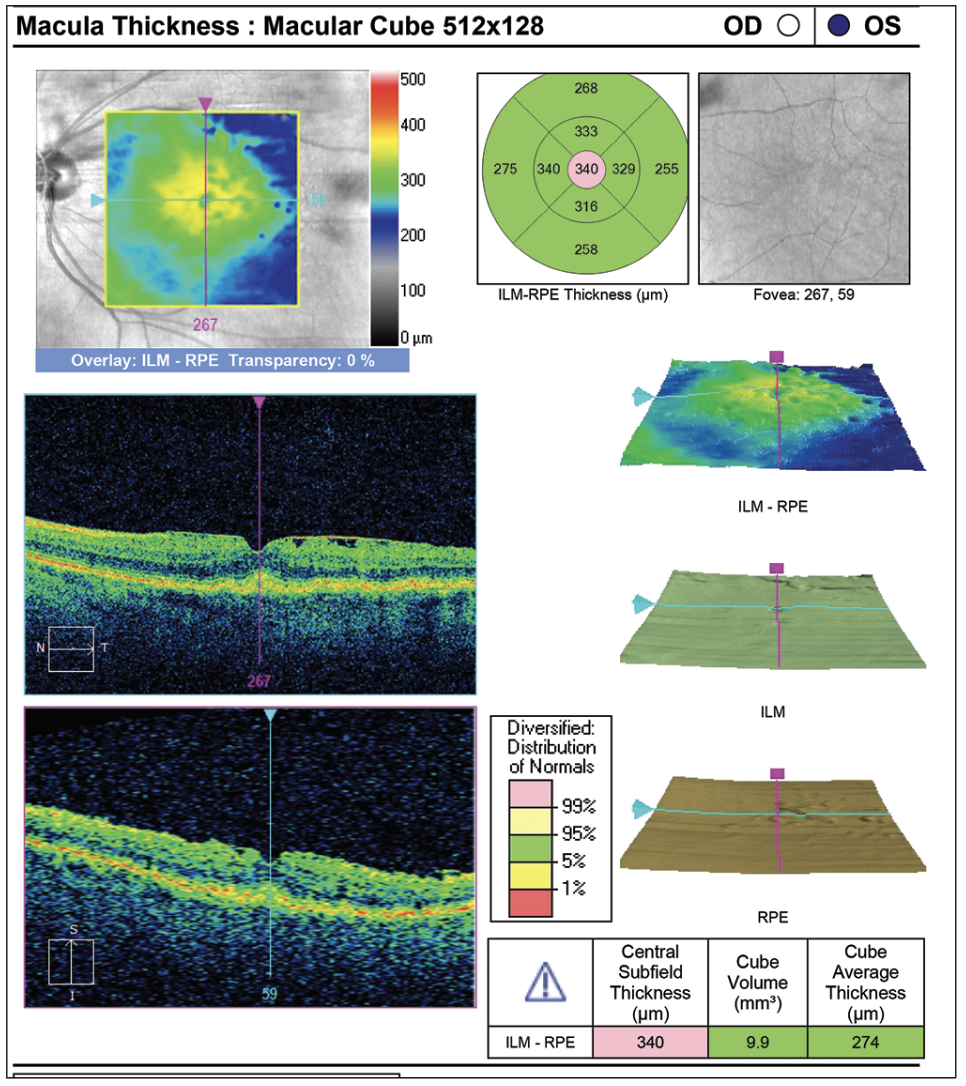 Typical ERM resulting in macular thickening and inner retinal corrugations.