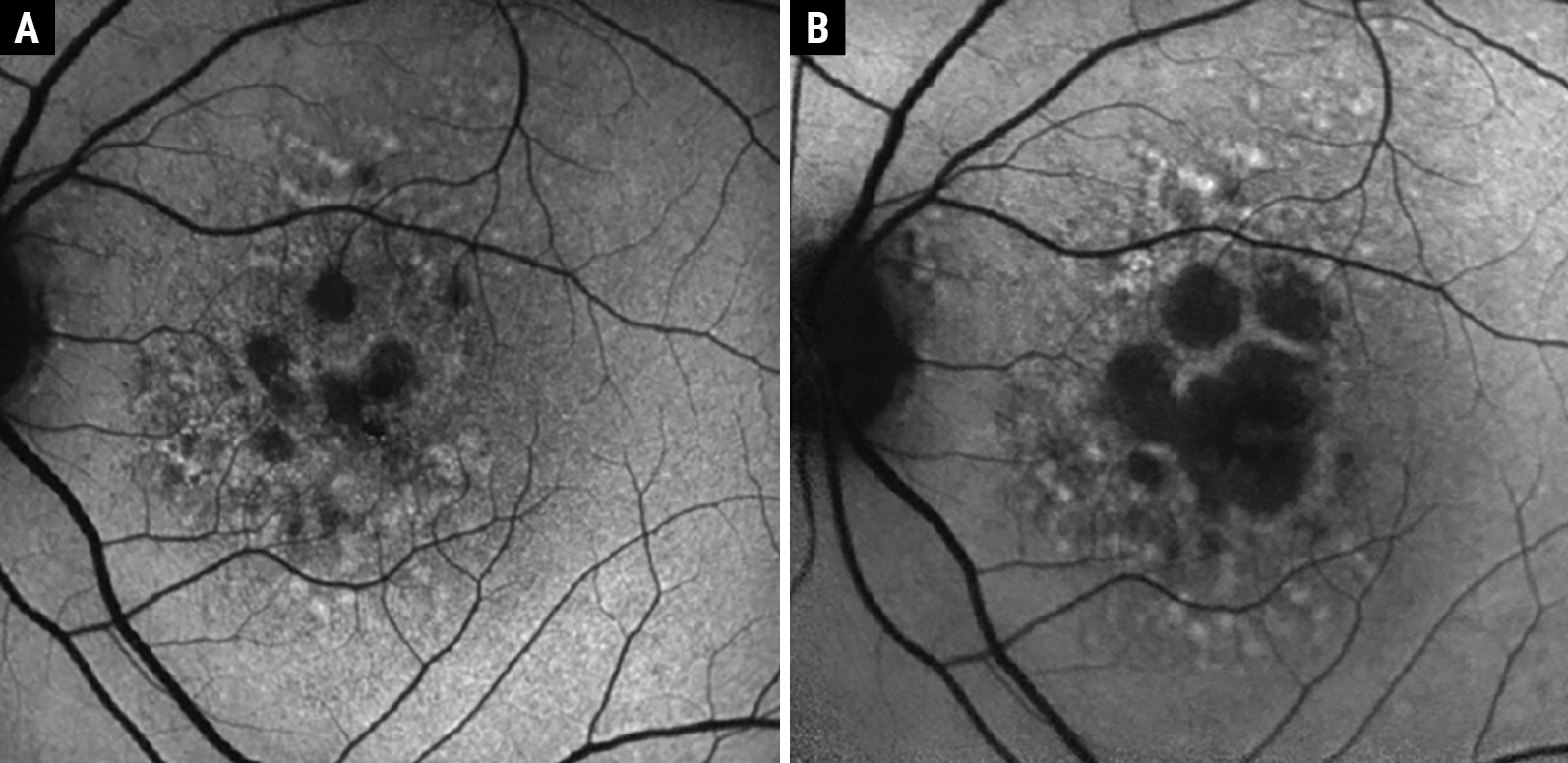 Fig. 2. Example of GA progression over two years with FAF. At baseline, the patient had numerous small atrophic lesions (A). After two years, there was significant enlargement of the GA lesions encroaching the fovea (B); however, visual acuity was maintained at 20/25. Despite good visual acuity, this patient has substantial photoreceptor loss and suffers from other deficits of visual function that should trigger a referral to a vision rehab specialist. 