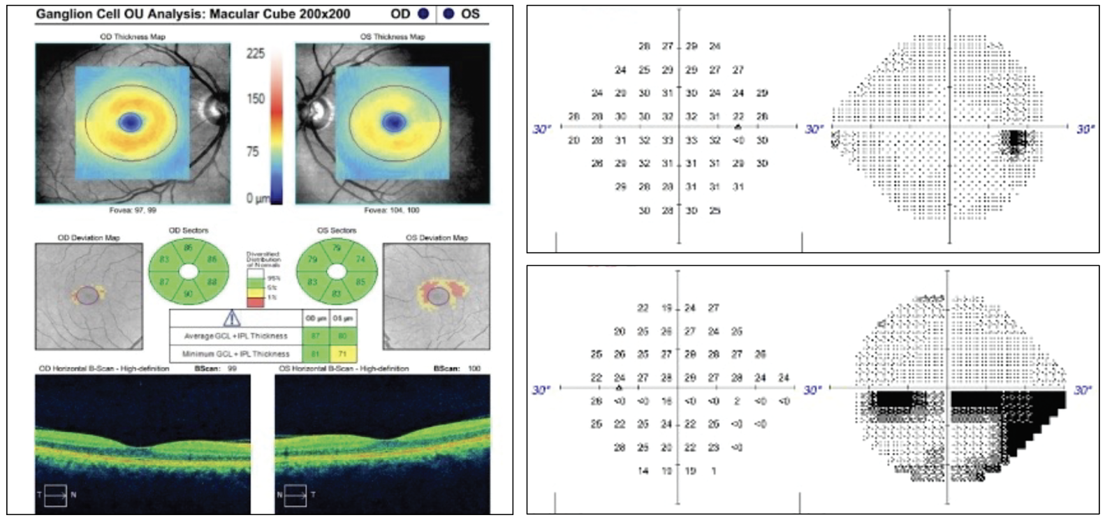 Fig 1. OCT ganglion cell analysis of the left eye indicated superior temporal thinning. The 24-2 visual field of the right eye was largely unremarkable but the left eye demonstrated an incomplete inferior altitudinal defect.