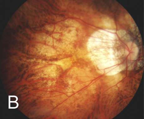 Regional and ethnic differences in axial elongation are age-specific, a recent study determined. These two demographic factors had the greatest effect in younger eyes with myopia, although region and ethnicity also appeared to affect axial elongation estimates in emmetropic eyes.