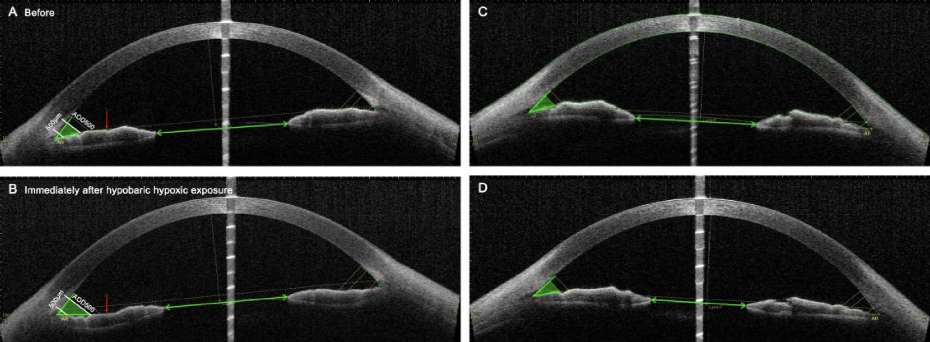 Reduced oxygen concentration at high altitudes may induce pupil miosis accompanied by increased iris volume, study finds. This image from the study shows how hypobaric hypoxia-induced pupil miosis flattened the iris and widened the anterior chamber angle in individuals with convex irises (B, D), while those with concave irises (A, C) experienced increased concavity, leading to a wider angle.