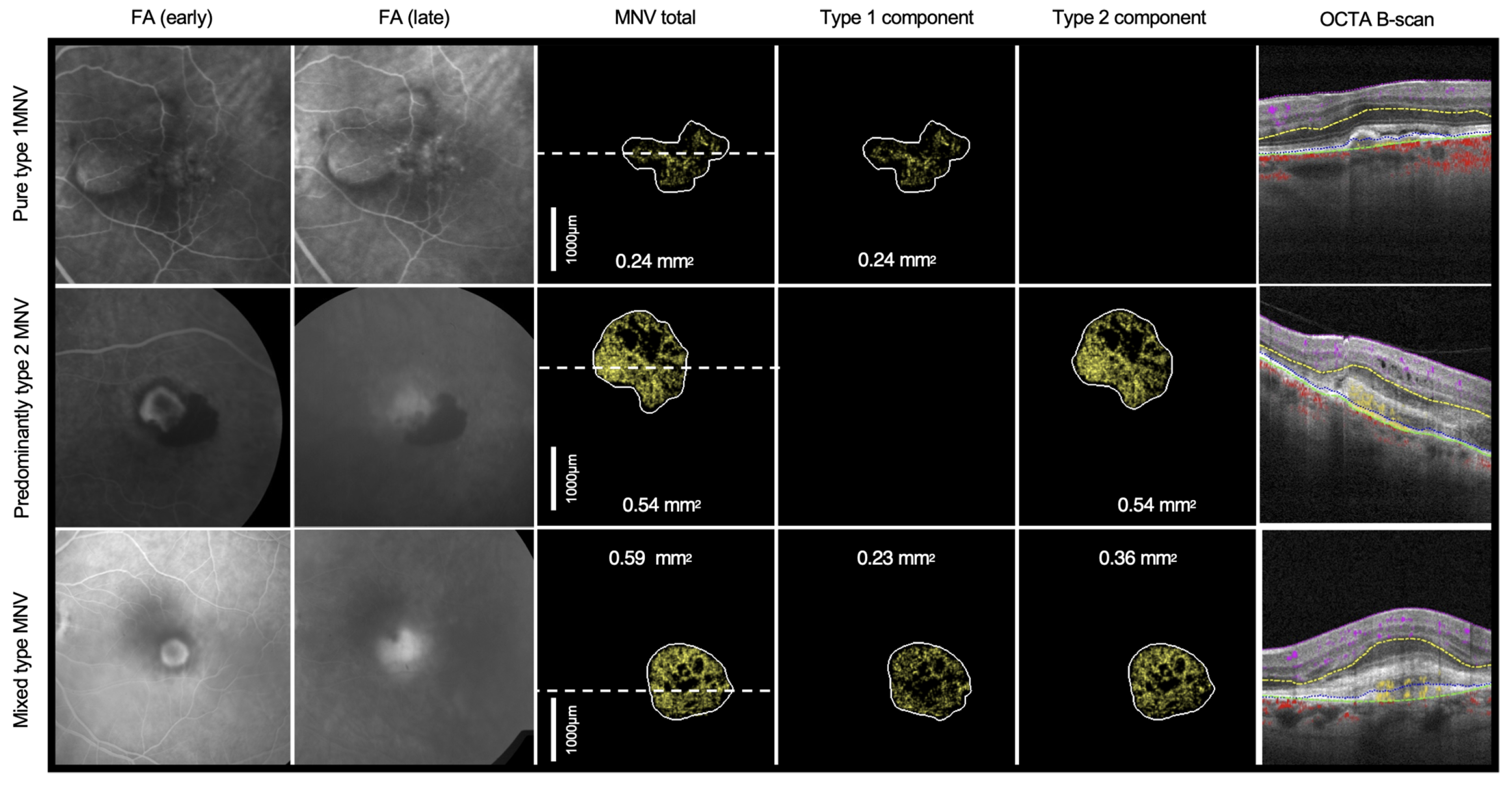 OCT-A scans reveal distinct responses in type 1 and type 2 macular neovascularization following one year of anti-VEGF treatment in patients with age-related macular degeneration. This image from the study shows representative examples of MNV type based on OCT-A classification, with corresponding early and late FA. 