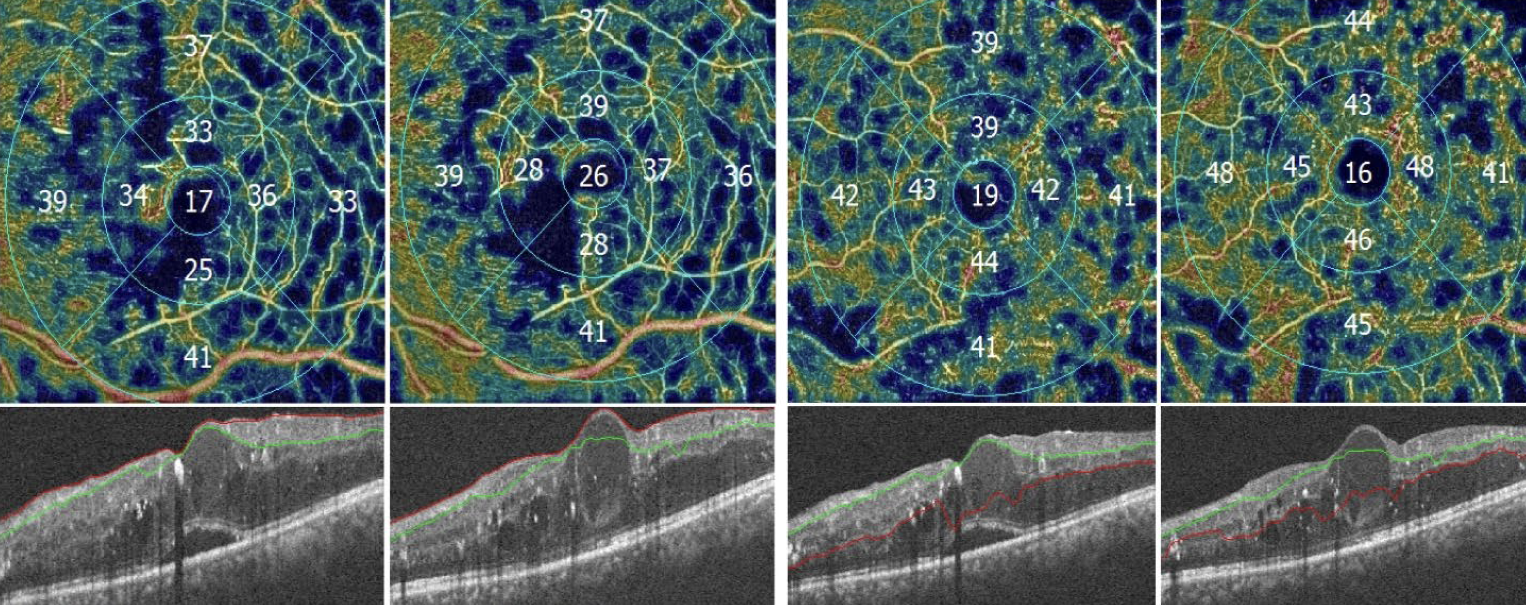 Researchers found that several baseline measurements on OCT-A—specifically the vascular density in the superficial and deep capillary plexuses and FAZ area size—can predict an early-treatment response to intravitreal ranibizumab in DME patients.