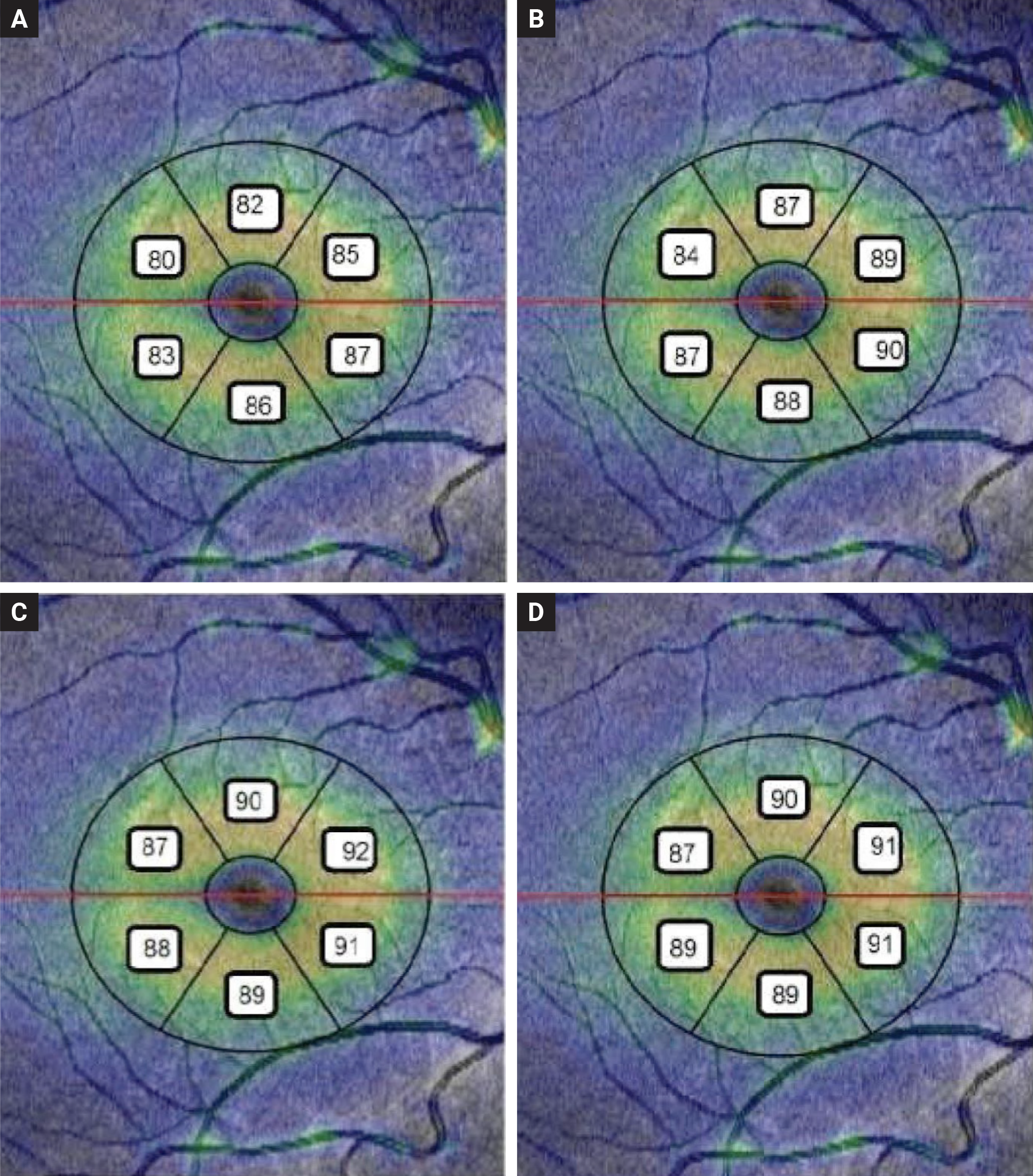 Children with a history of retinopathy of prematurity (ROP) display unique eye characteristics, such as shorter axial lengths and thicker macula, according to a recent study published in the Journal of Ophthalmology. This image from the study shows thee mean GCL + IPL thickness of six sectors in four studied group: (a) treated ROP; (b) regressed ROP; (c) preterm without ROP; (d) full-term children.