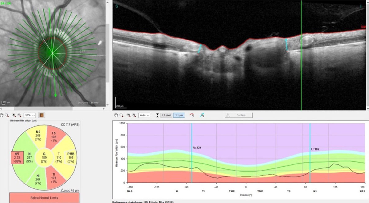 A computer simulation-based approach investigated risk factors for POAG progression. In the early stages of POAG, the rate of decrease in RNFL thickness accelerated with increasing mean or maximum strain on the lamina cribrosa. Additionally, the lamina cribrosa strain was associated with ONH geometric factors and IOP.