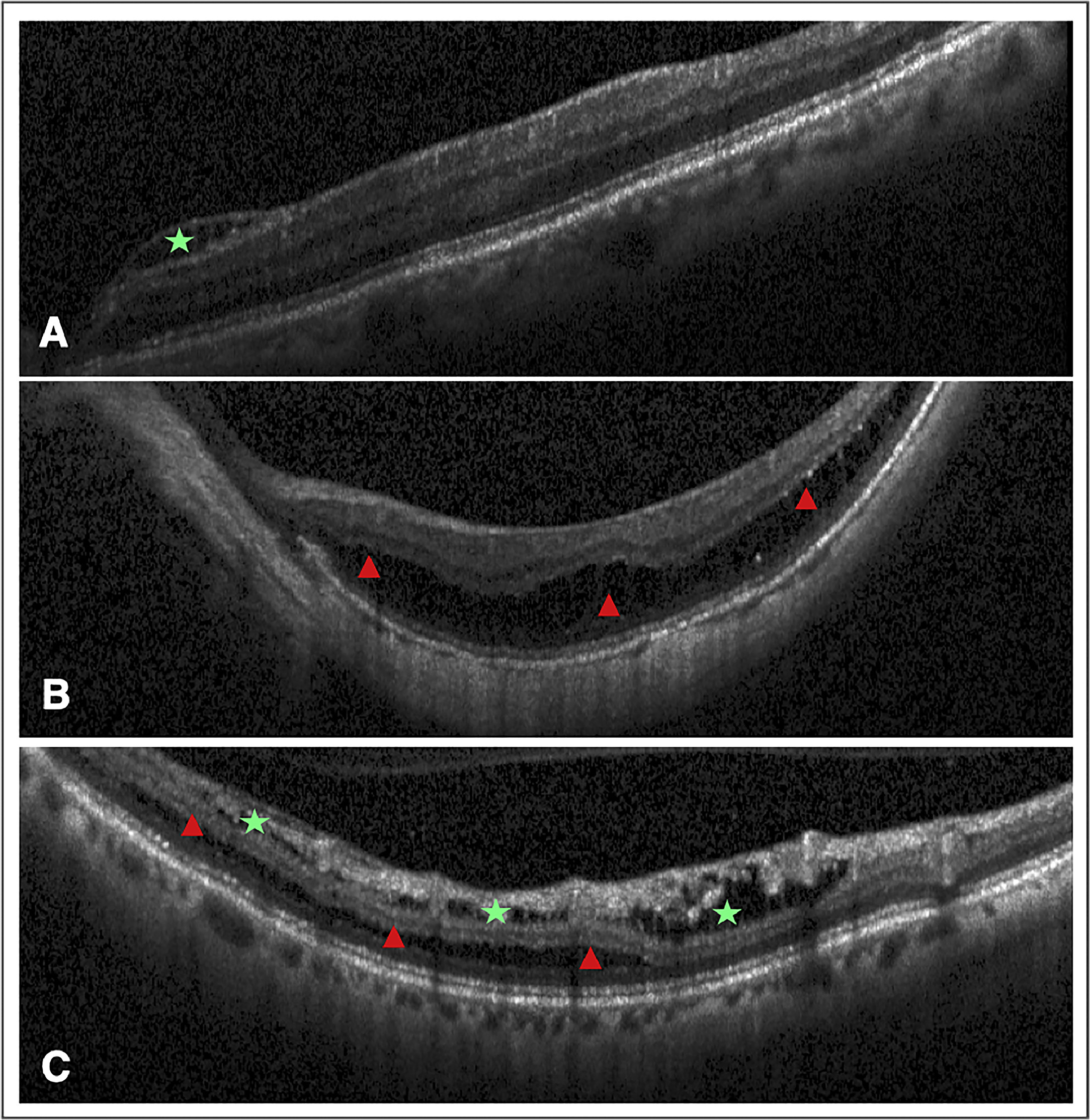 Research shows a significant prevalence of macular retinoschisis in elderly patients with high myopia, identifying critical risk factors and the need for vigilance to preserve visual outcomes. This image from the study illustrates two MRS types: (A) inner retinoschisis, affecting layers from the retinal nerve fiber to the inner nuclear layer (green star), and (B) outer retinoschisis, involving layers from the outer plexiform layer to the retinal pigment epithelium (red triangle). Cases with both types concurrently in the same eye are noted (C).