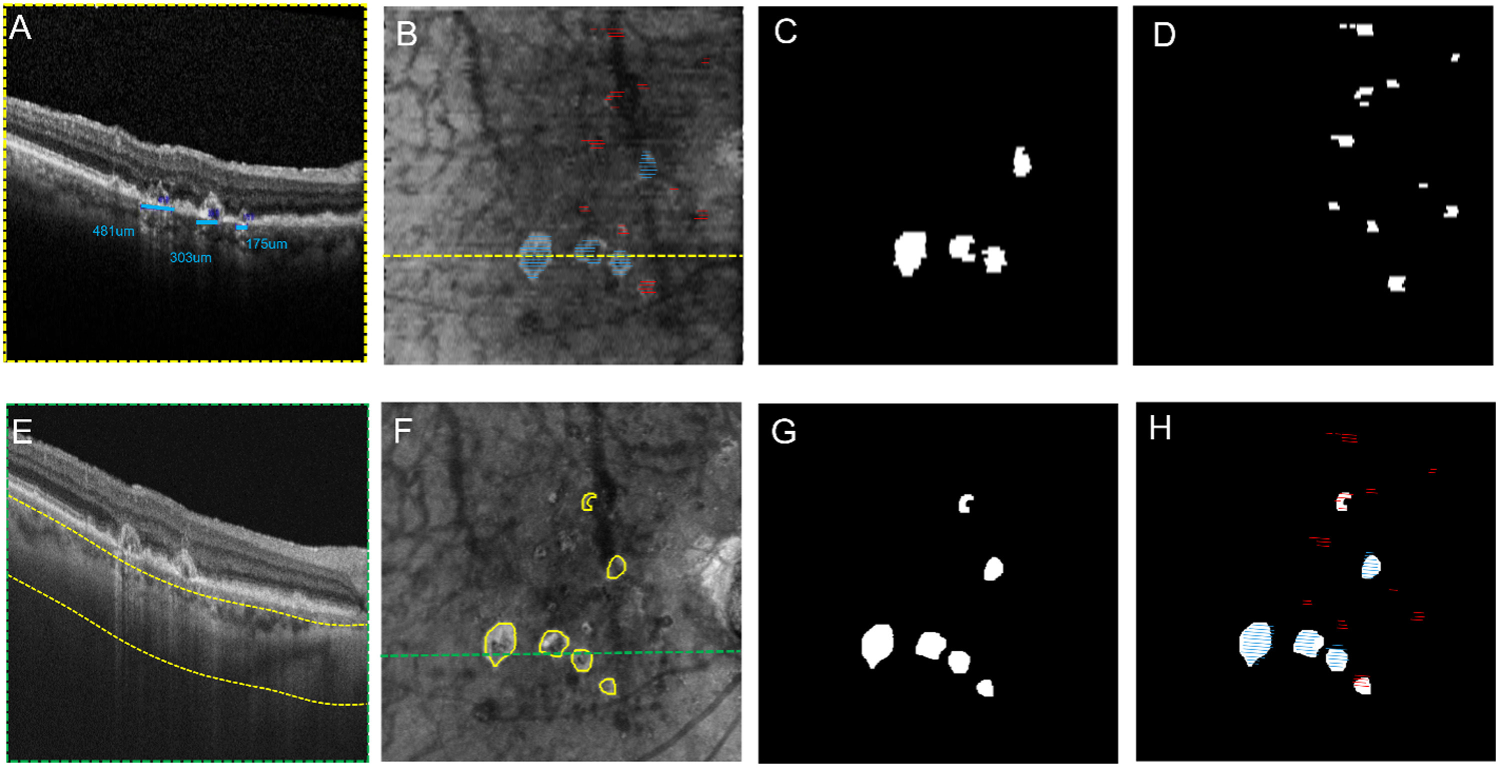 A recent study demonstrates that en face OCT imaging effectively identifies complete RPE and outer retinal atrophy (CRORA) lesions, while also emphasizing the necessity of dense raster B-scans and adjacent B-scan grading for accurate detection of incomplete (iRORA) lesions, especially in non-horizontal dimensions. These images from the study show the process of identification of iRORA and cRORA in a representative eye using SD-OCT and SS-OCT instruments: (A) SD-OCT B-scan with blue lines denoting cRORA, (B) En face image of sub-RPE slab obtained from the SD-OCT scan. Persistent choroidal hypertransmission defects (hyperTDs) are visible across the entire scan area with the overlay of lines corresponding to cRORA (blue lines) and iRORA (red lines). (C) An en face cRORA mask was generated based on B-scan gradings on SD-OCT. (D) An en face iRORA mask was generated based on its B-scan gradings on SD-OCT. 