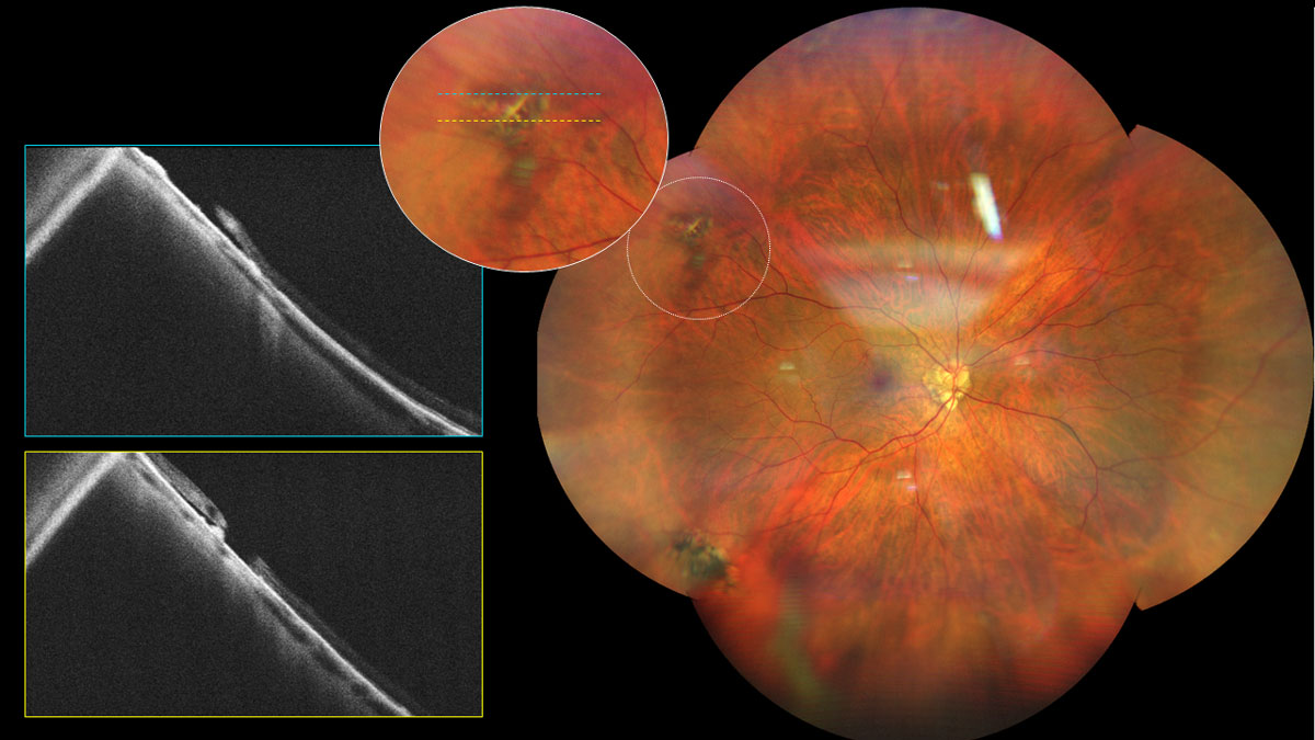 A cross-sectional study showed that in longer eyes, failing to correct for ocular magnification leads to perceived narrowing of retinal vessels, while incorrect assumptions about telecentricity during magnification correction cause apparent vessel widening. This image is showing lattice degeneration in a high myope.