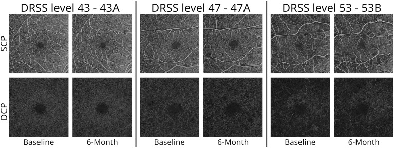 According to a recent study, OCT-A can play an important role in detecting microvascular changes in patients with moderate to severe NPDR. Researchers found that capillary hypoperfusion progresses significantly at advanced disease stages in the foveal avascular zone, skeletonized vessel density and perfusion density metrics for the inner and outer ring areas. They also discovered the rate of microaneurysms increases with disease severity. These findings could potentially pave the way for future clinical trials aimed at preventing the progression of diabetic retinopathy and its associated vision-threatening complications. This image from the study shows superficial and deep capillary plexus images acquired using swept-source OCT-A from patients with diabetic retinopathy severity levels 43, 47 and 53 in six-month intervals.