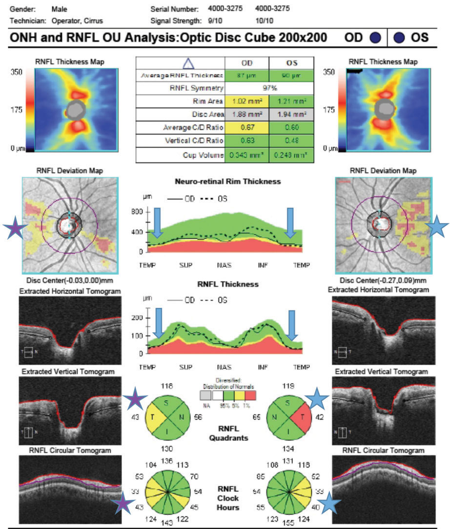 Understanding the complex relationships among myopia severity, structural changes and functional changes can give clinicians a higher index of suspicion for glaucoma in affected individuals.