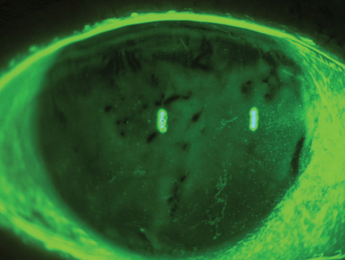 Inflammatory cytokines associated with depression have been found elevated in DED patients, suggesting systemic inflammation could play a biological role in the coexistence of these disorders. 