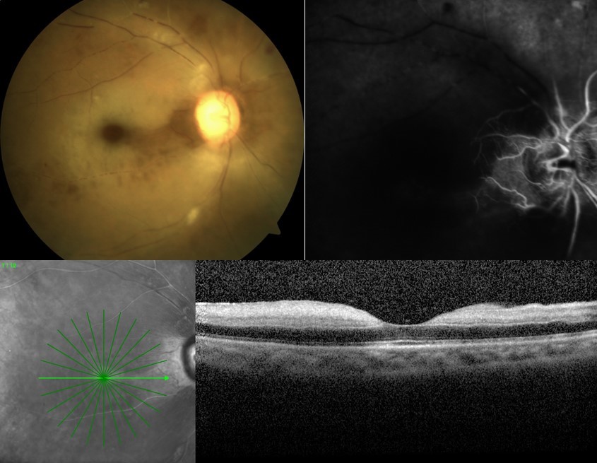 In patients with a history of cerebro-cardiovascular disease, the risk of RAO increased during the late risk period, with an incidence rate ratio of 1.19.