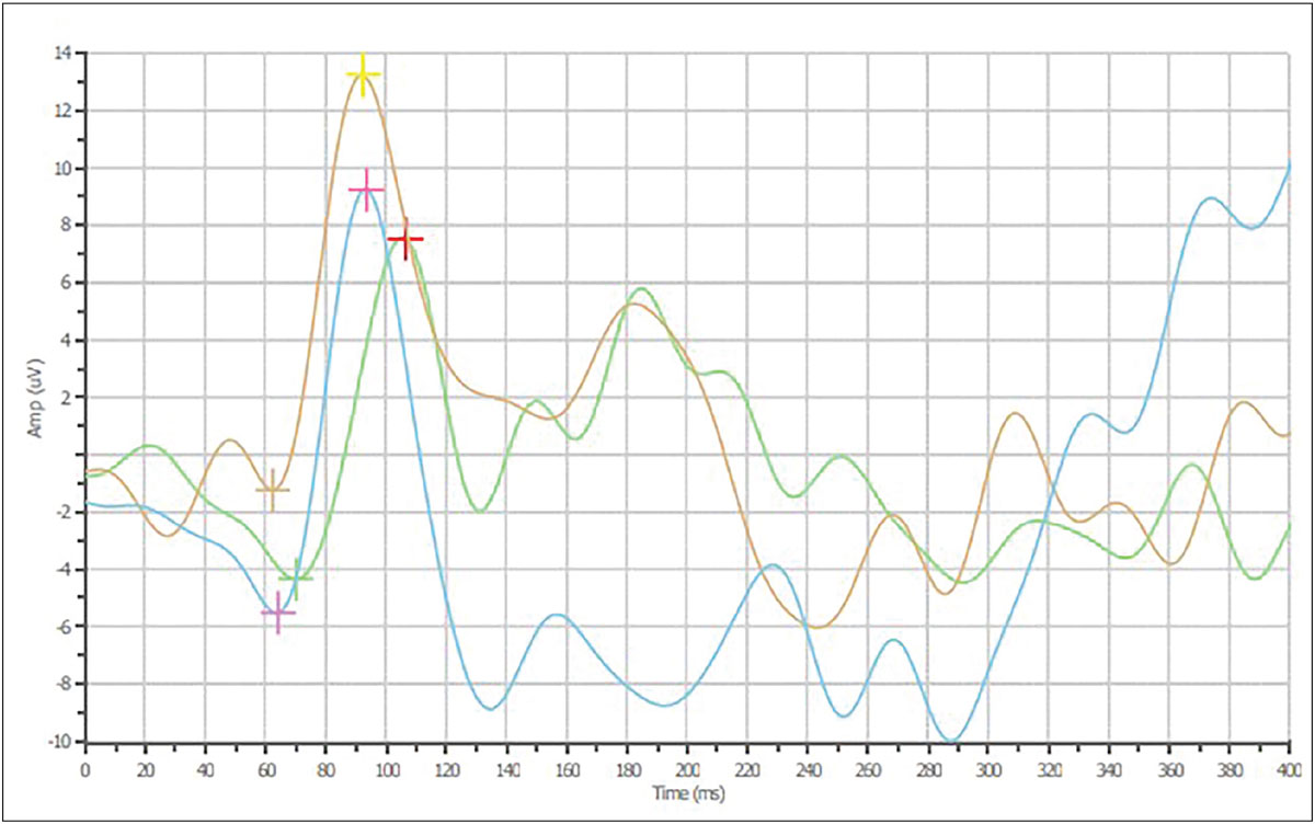 Fig. 1. VEP for the 16x16 spatial frequency showing lower amplitude (106.4ms OD, 95.8ms OS, 93.7ms OU) and increased latency (11.90µV OD, 14.44µV OS, 14.75µV OU).