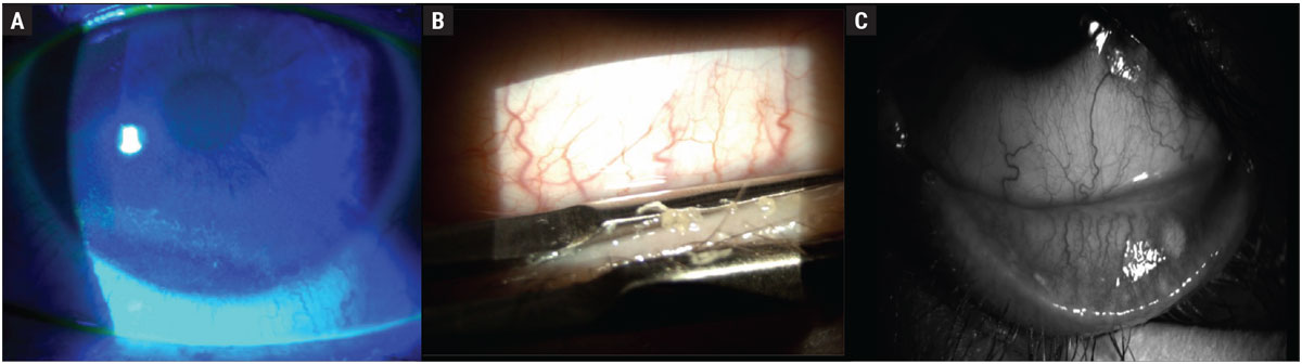 Fig. 2. Examples of corneal surface and tear film effects of neurodegenerative diseases: (A) corneal epithelial erosions, which stain positive with fluorescein, (B) inspissated meibomian glands, which can undergo in-office expression, (C) atrophy and dropout of meibomian glands.