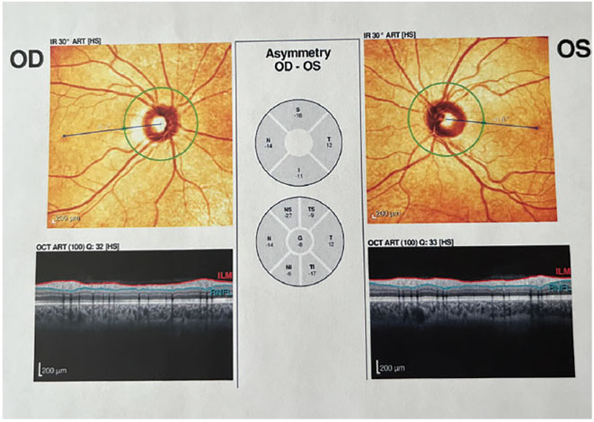 Fig. 1. OCT with no abnormalities present.