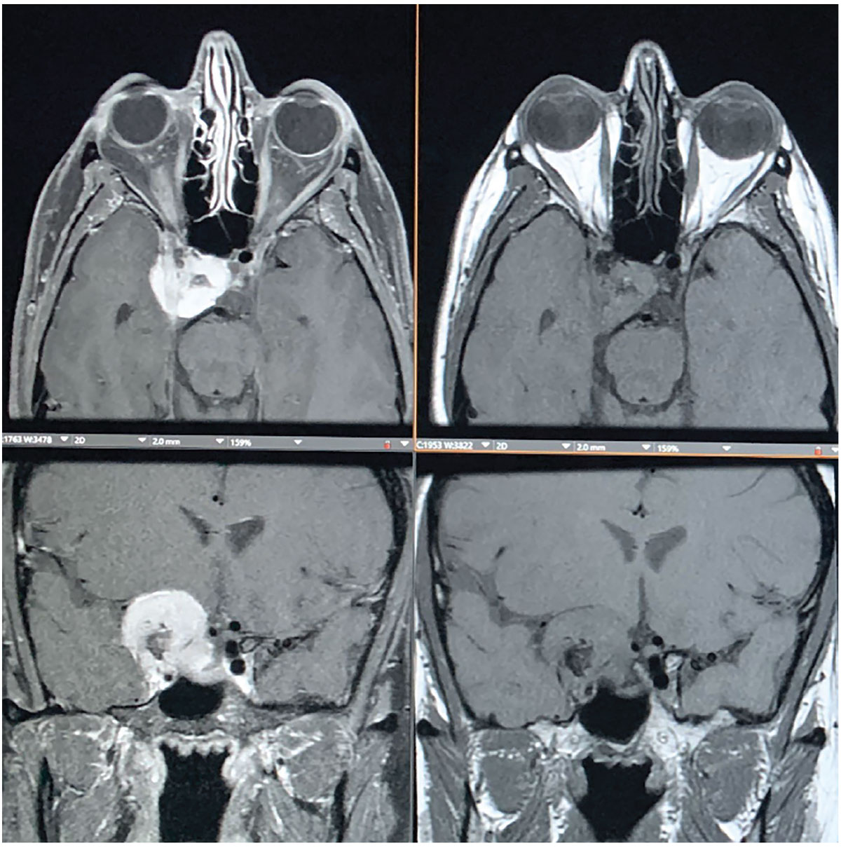 Fig. 3. MRI shows an avidly enhancing extra-axial mass centered along the right anterior clinoid process, also with a medial displacement of the right optic tract with narrowing and encasement of right optic nerve. The mass extends to the right aspect of the sella turcica and extends inferiorly into the right cavernous sinus.