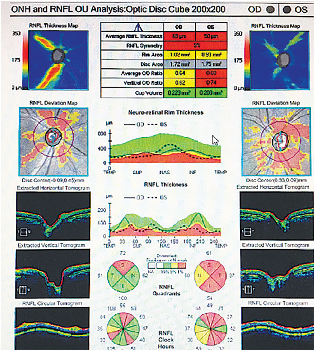 Fig. 5. Bilateral retinal nerve fiber loss OU in a patient with MS without a history of optic neuritis.