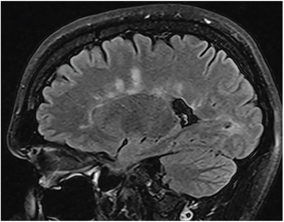 Fig. 6. This patient with right retrobulbar optic neuritis presented with subacute vision loss and pain on eye movement. An MRI brain scan revealed periventricular white matter lesions suggestive of a demyelinating disease.