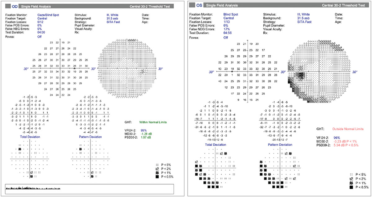 Fig. 8. Visual fields in NAION. Normal field OD and an inferior altitudinal defect OS. 