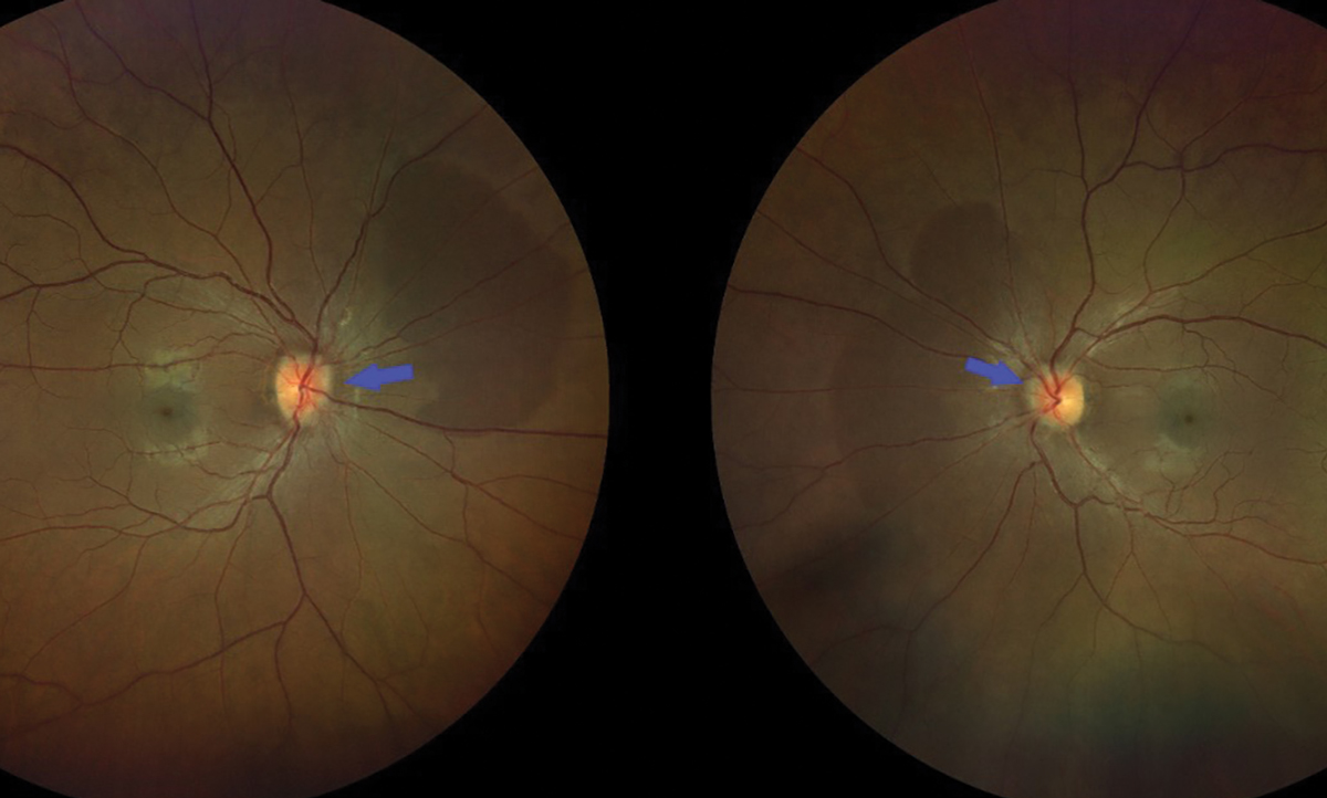 Fig. 1. Color fundus photo showing bilateral optic nerve head edema, characterized by indistinct margins which are indicated by the blue arrows.