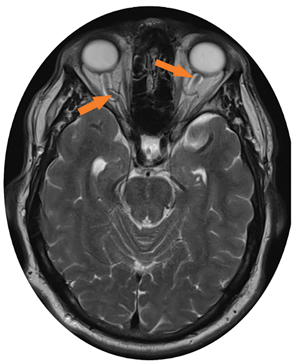 Fig. 2. This axial MRI of the brain without contrast shows the dilated (up to 8mm) and tortuous optic nerve sheaths, as indicated by the orange arrows.