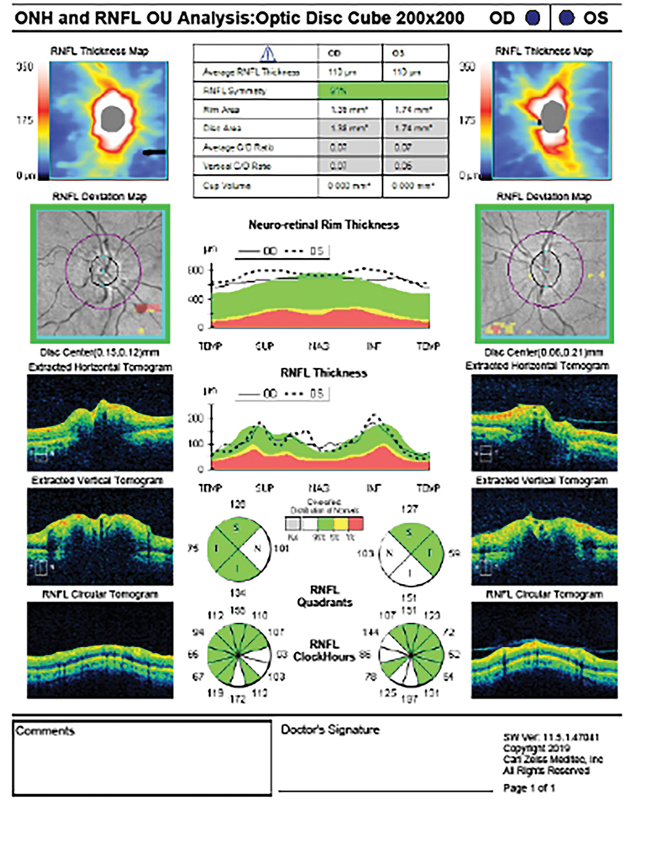 Fig. 3. The OCT-RNFL scan shows thickening of the nerve fiber layer in both eyes secondary to bilateral disc edema from IIH. This is evident on the RNFL thickness map, where a double rainbow sign indicates the areas of edema.