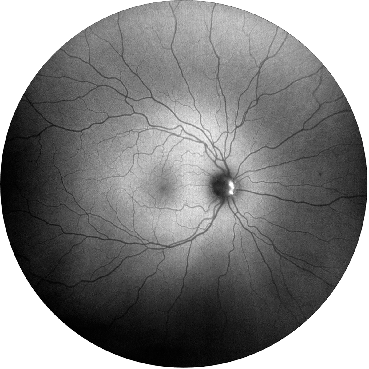 Fig. 4. Fundus autofluorescence photo showing hyperfluorescence within the nasal aspect of the optic nerve in the right eye due to optic nerve head drusen.