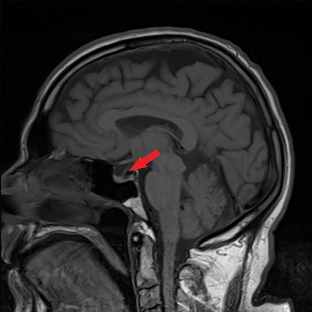 Fig. 5. This sagittal MRI of the brain without contrast shows a partially empty sella, as indicated by the red arrow.  