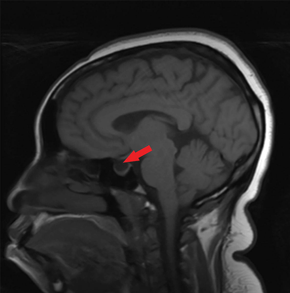 Fig. 6. This sagittal T1 weighted MRI of the brain without contrast shows an empty sella, as indicated by the red arrow.