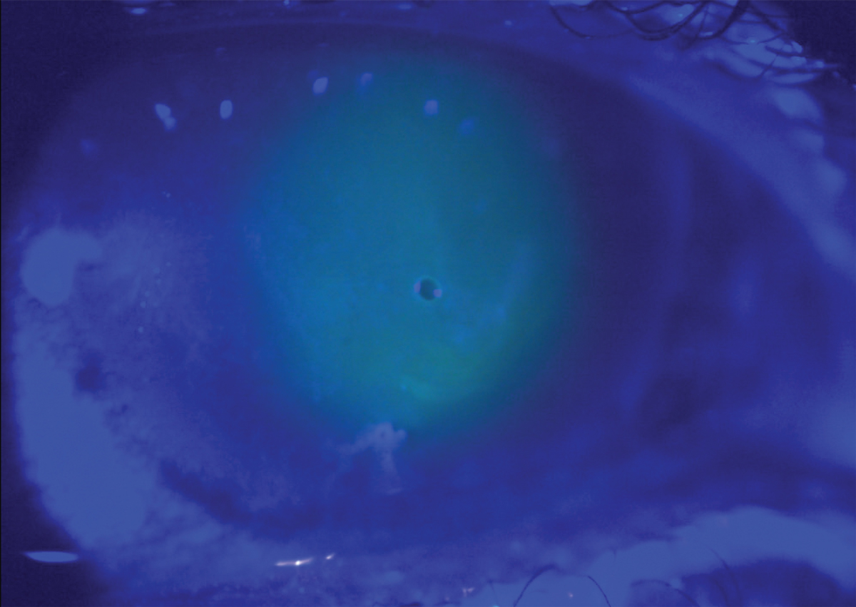 Large corneal erosion in a patient with lattice corneal dystrophy with bandage contact lens in place.