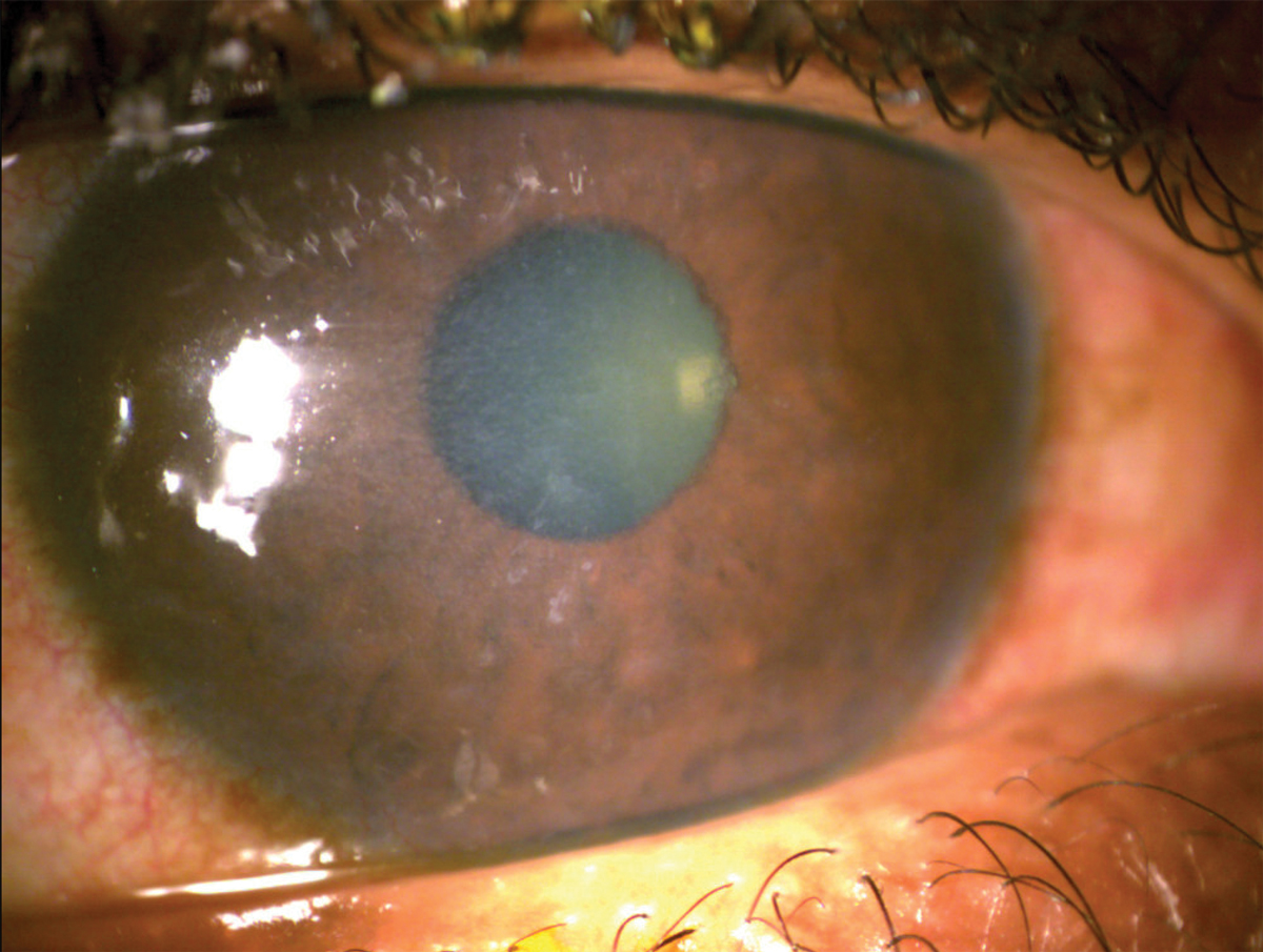 Irregular epithelium following reepithelialization post-corneal erosion in lattice corneal dystrophy.