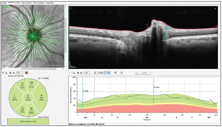 Fig. 1. Bruch’s membrane opening-minimum rim width (BMO-MRW) measurements of the neuroretinal rim in the patient’s right eye. Note the robust neuroretinal rim, small optic cup and slightly small optic disc size.