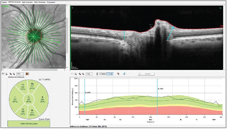 Fig. 3. Note one small area of slightly thinned RNFL and global thinning of the temporal and inferior temporal Garway-Heath sectors.