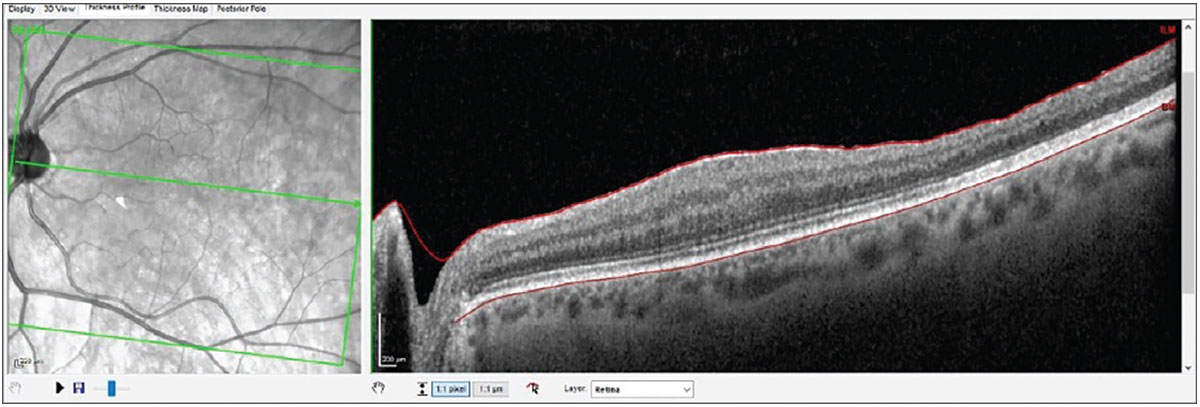 Fig. 4. Note the normal retinal anatomy on the nasal side of the fovea and the thinned, disrupted retinal anatomy temporal to the fovea, secondary to the membrane peel.